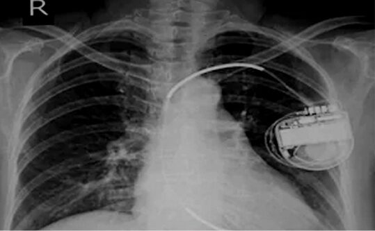 Implantable Monitoring X-ray